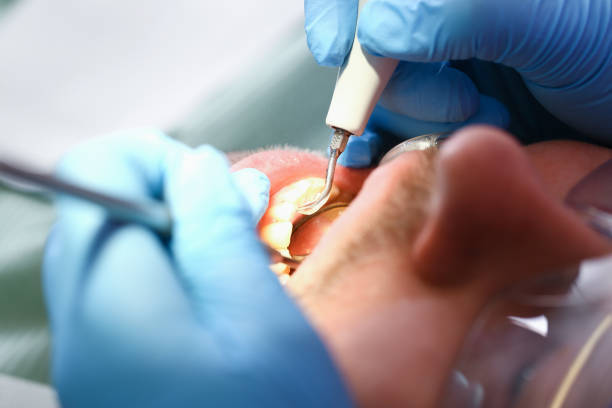 Best Emergency Tooth Extraction in Jacksonville, OR